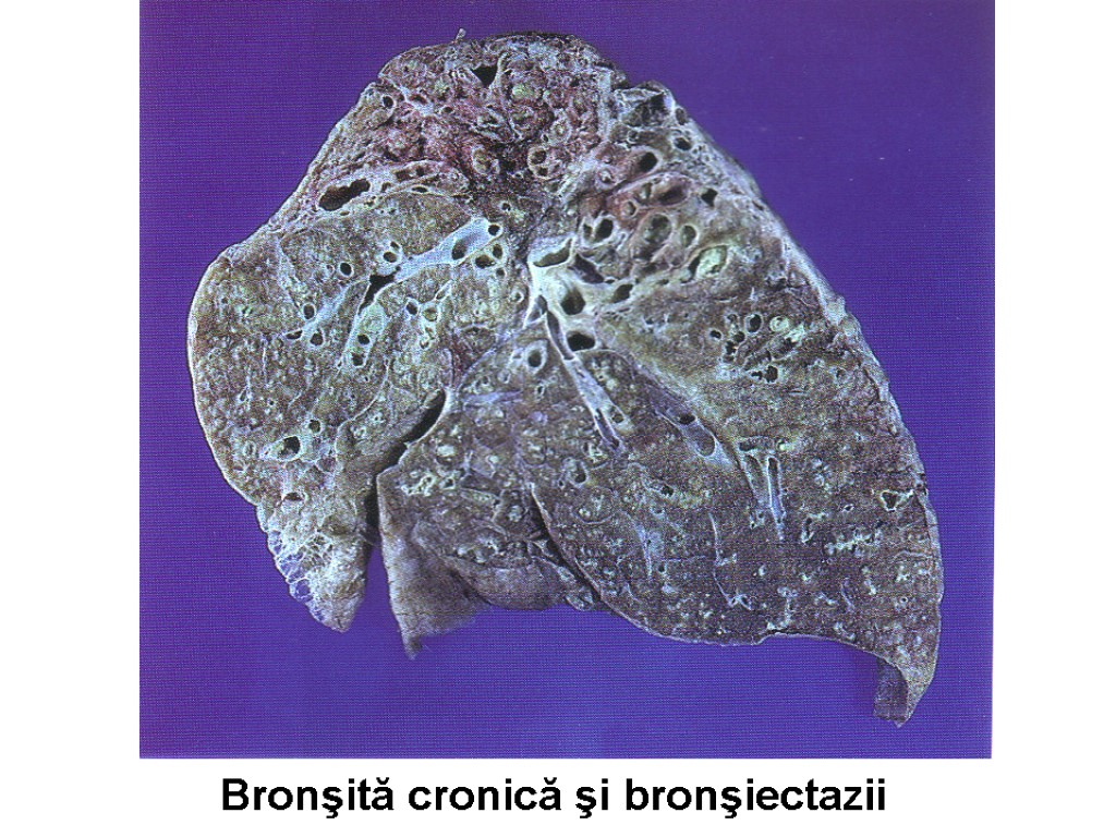 Bronşită cronică şi bronşiectazii